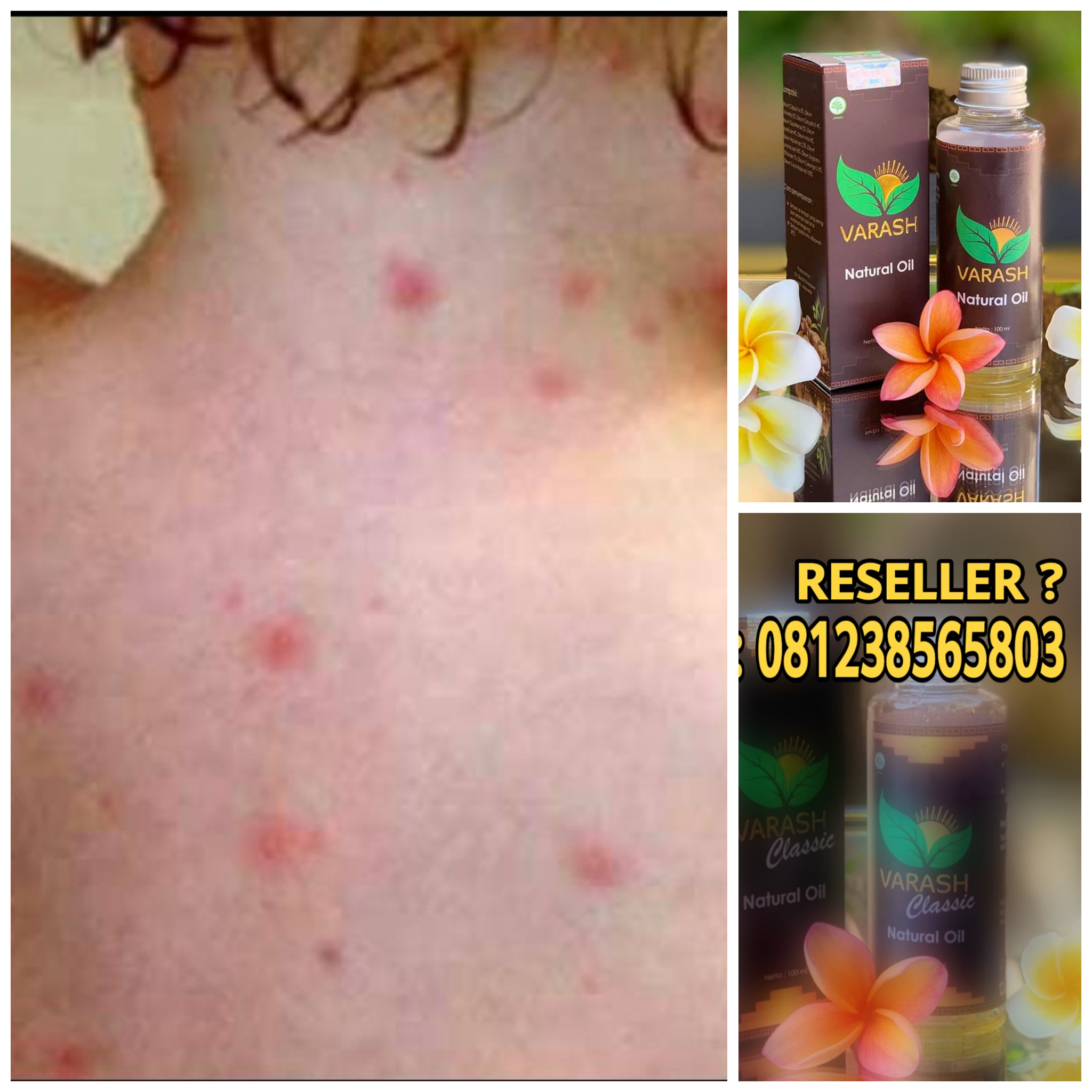 Cacar Air Dan Varash Natural Oil Cara Cepat Menghilang